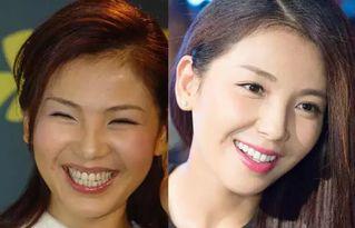 明星大白牙贴面视频,揭秘明星牙齿贴面美颜术